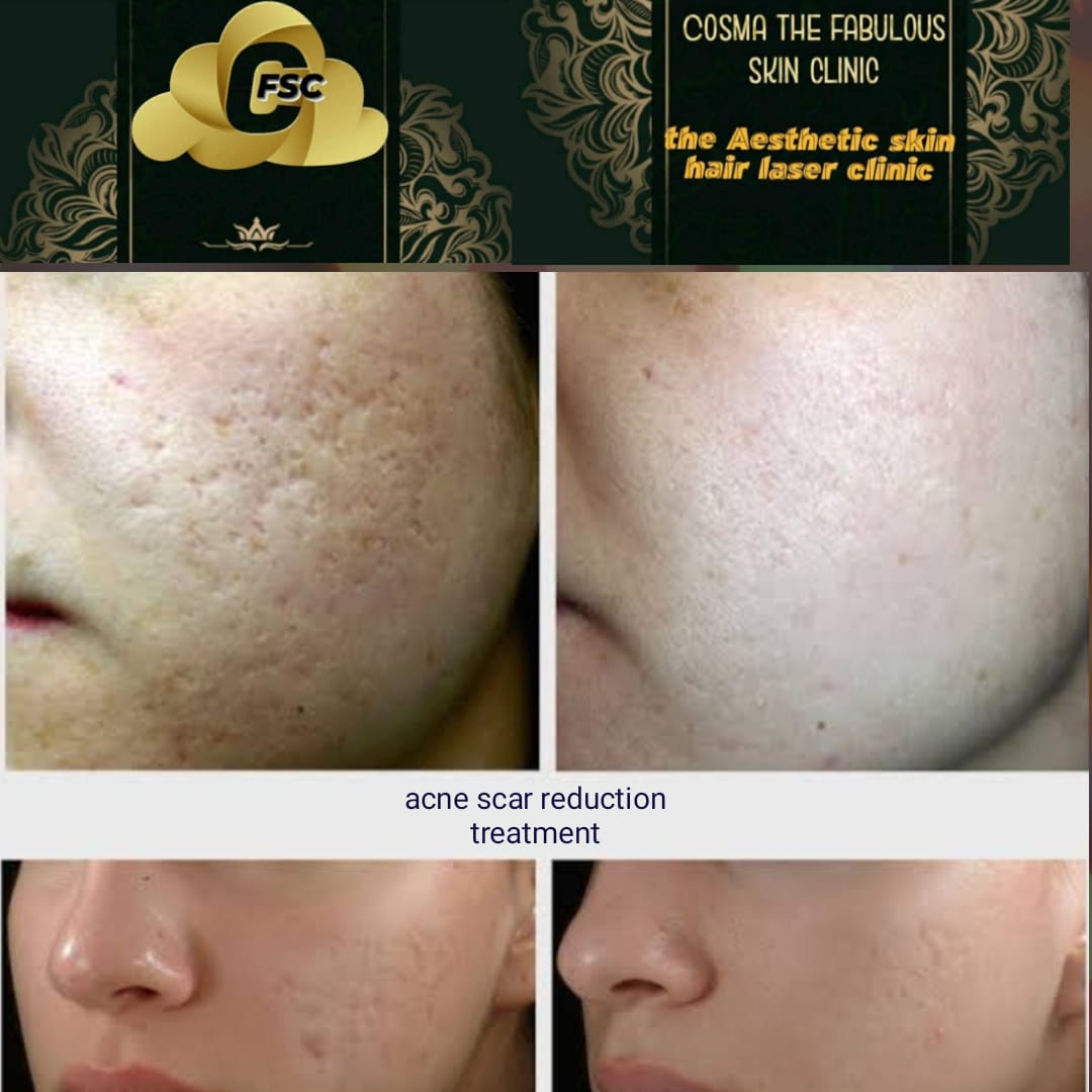 Before After Facial Treatment
